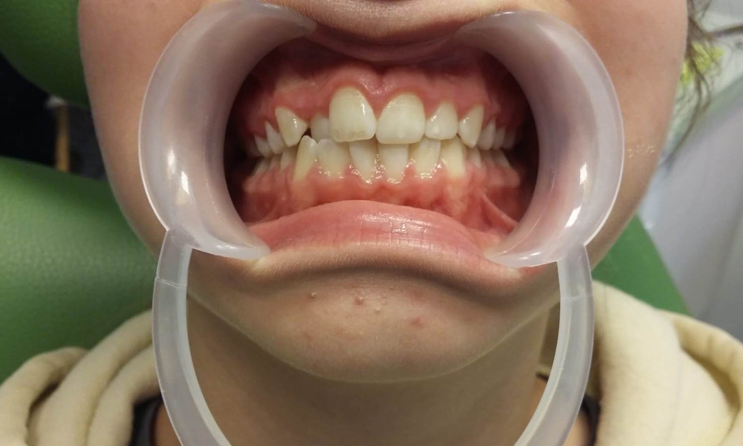 Pacjentka 2 przed leczeniem ortodontycznym expander